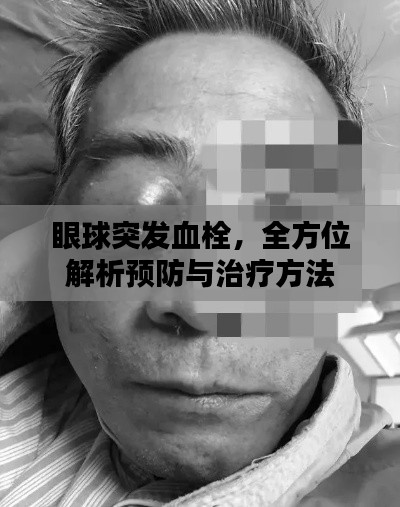 眼球突发血栓，全方位解析预防与治疗方法