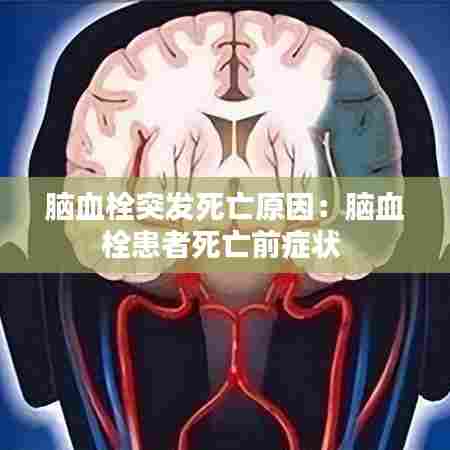 脑血栓突发死亡原因：脑血栓患者死亡前症状 