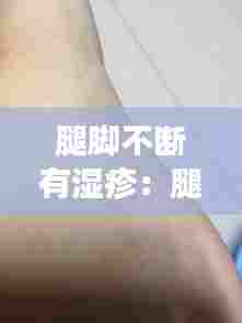 腿脚不断有湿疹：腿有湿疹怎么回事 