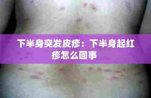 下半身突发皮疹：下半身起红疹怎么回事 