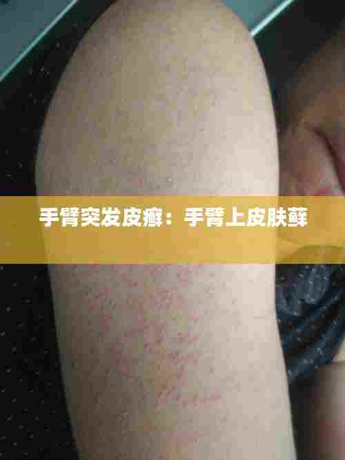 手臂突发皮癣:手臂上皮肤藓