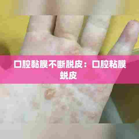 口腔黏膜不断脱皮：口腔粘膜蜕皮 