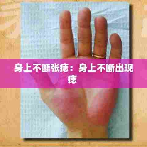 身上不断张痣：身上不断出现痣 