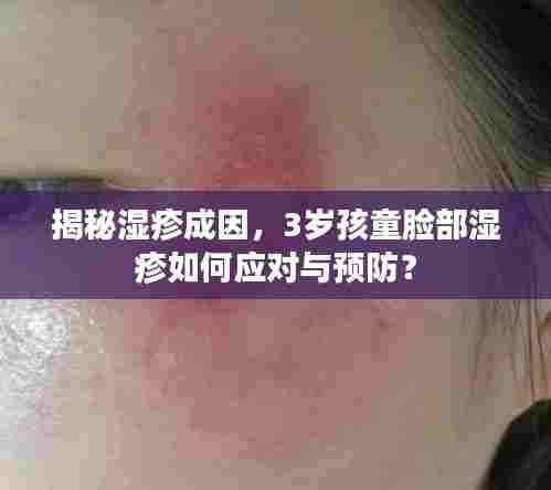 揭秘湿疹成因，3岁孩童脸部湿疹如何应对与预防？