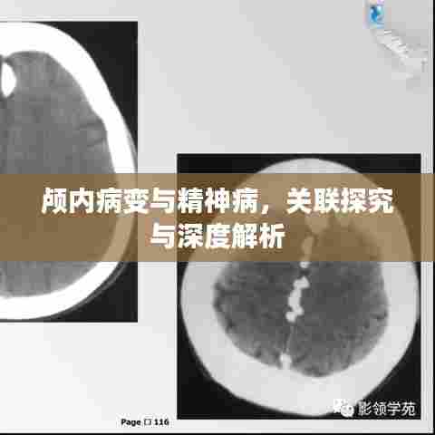 颅内病变与精神病，关联探究与深度解析
